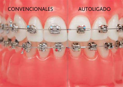 diferencia de brackets metalicos y autoligables|autoligado vs brackets convencionales.